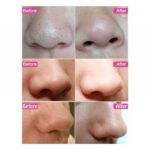 ماسک و چسب بینی مینیسو مخصوص جوش و مو زائد درون پوستی - Image 8