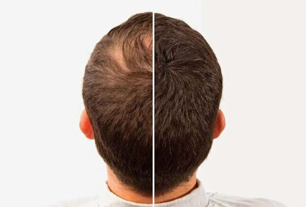 شامپو فیتو ولوم ضد ریزش و حجم دهنده و بدون سولفات مو نازک - Image 4